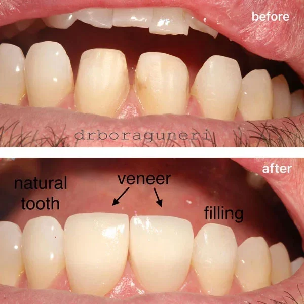 Smile gallery 1: original before-and-after dental photographs from Legacy Care