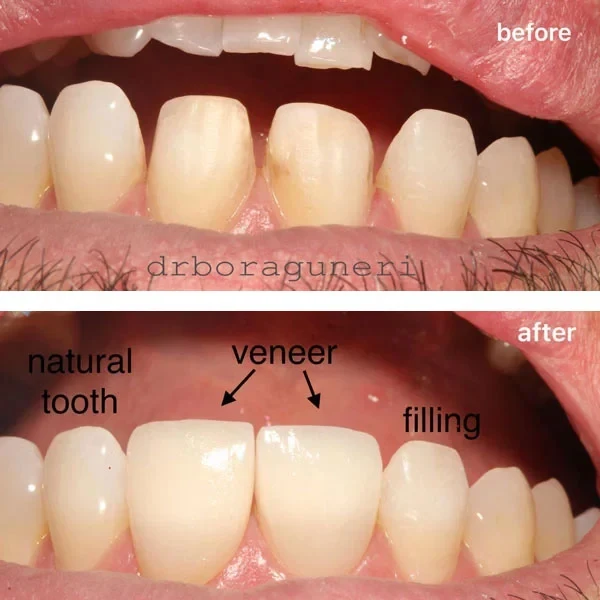 Smile gallery 1: original before-and-after dental photographs from Legacy Care