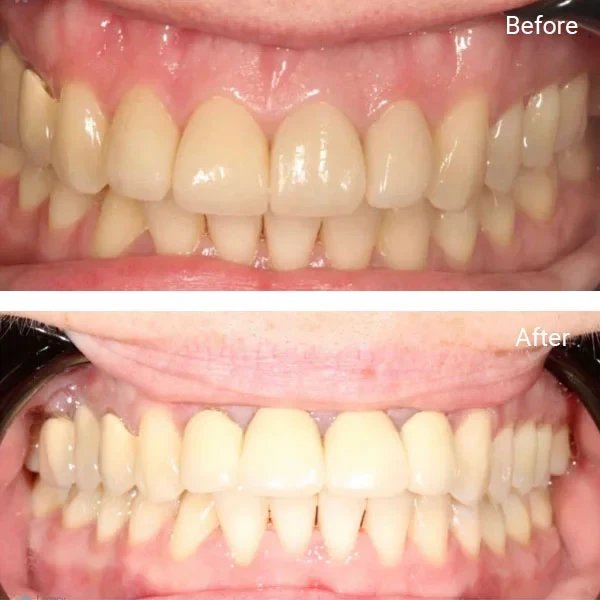 Smile gallery 3: original before-and-after dental photographs from Legacy Care