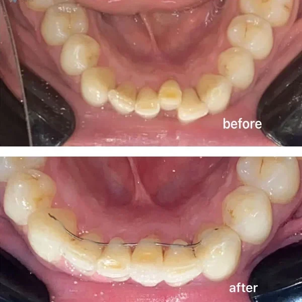 Smile gallery 4: original before-and-after dental photographs from Legacy Care