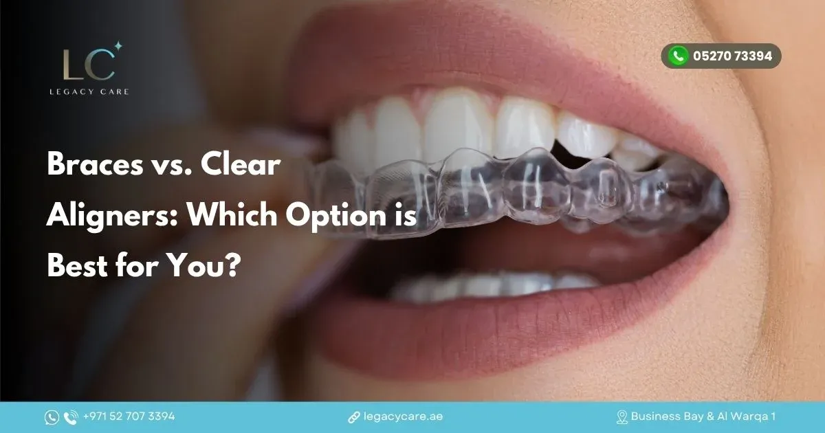 Braces vs. Clear Aligners: Which Option is Best for You?