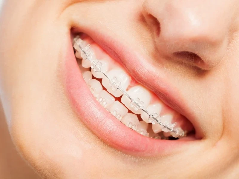 2. Ceramic Braces