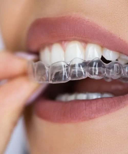 A clear aligner being placed over the front teeth