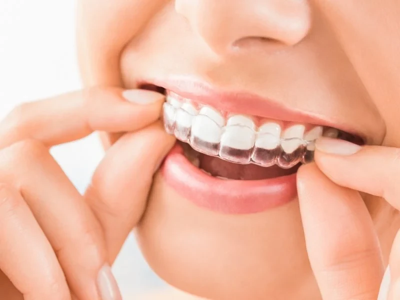 4. Clear Aligners (Invisalign)