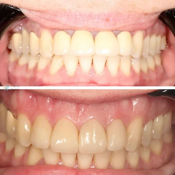 Smile gallery 6: original before-and-after dental photographs from Legacy Care