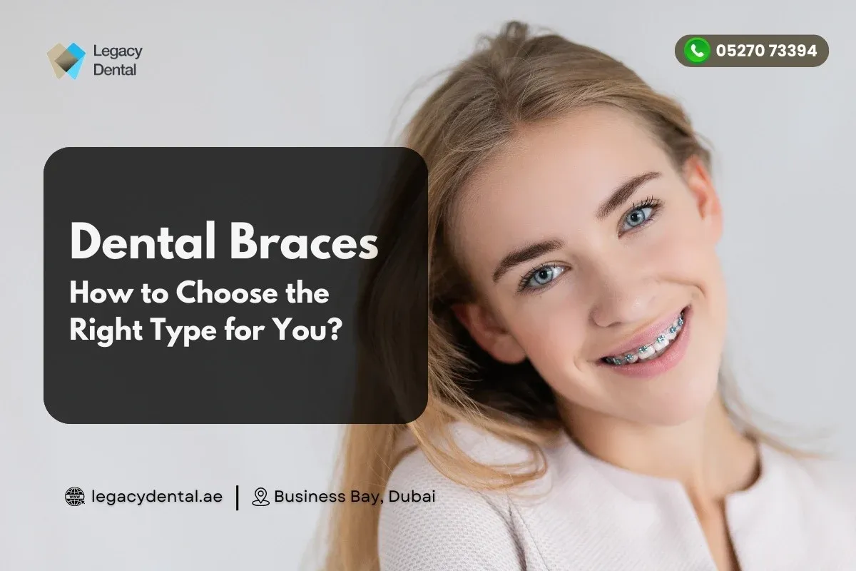 Dental Braces – How to Choose the Right Type for You