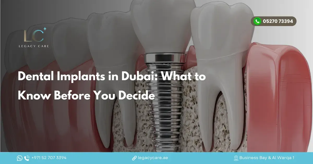 Dental Implants in Dubai: What to Know Before You Decide