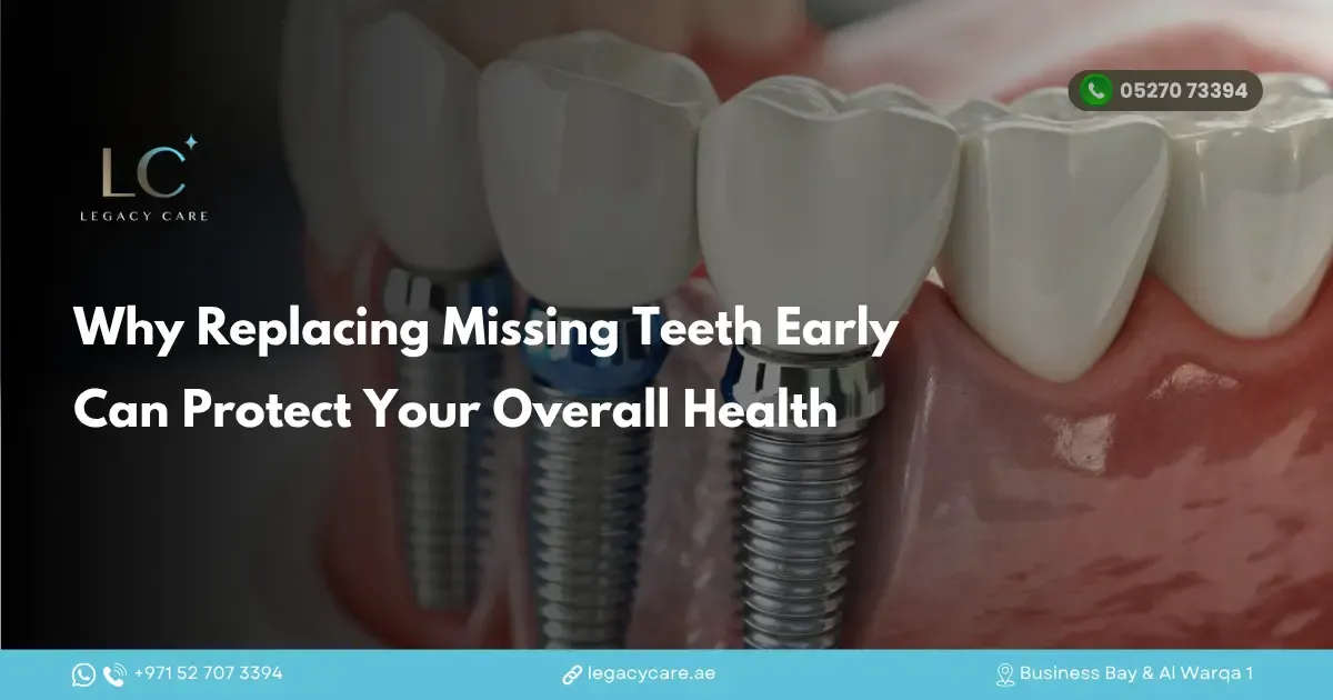 Why Replacing Missing Teeth Early Can Protect Your Overall Health