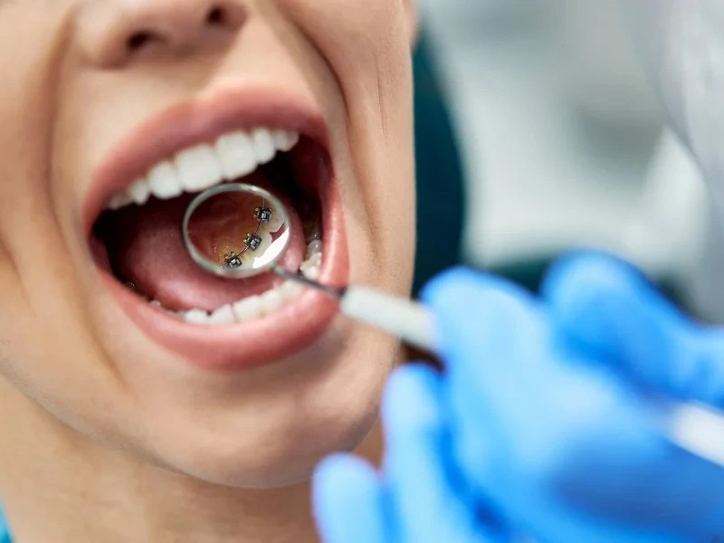 3. Lingual Braces