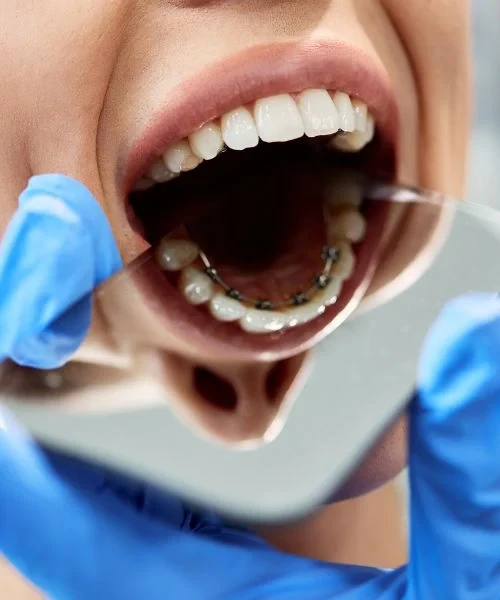 Brackets positioned on the inside surfaces of the teeth
