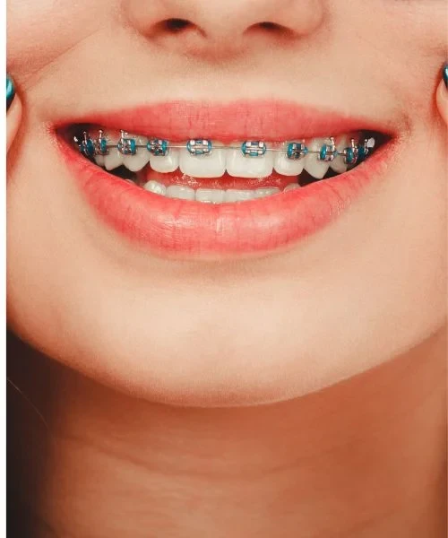 Metal brackets and an archwire on the front teeth