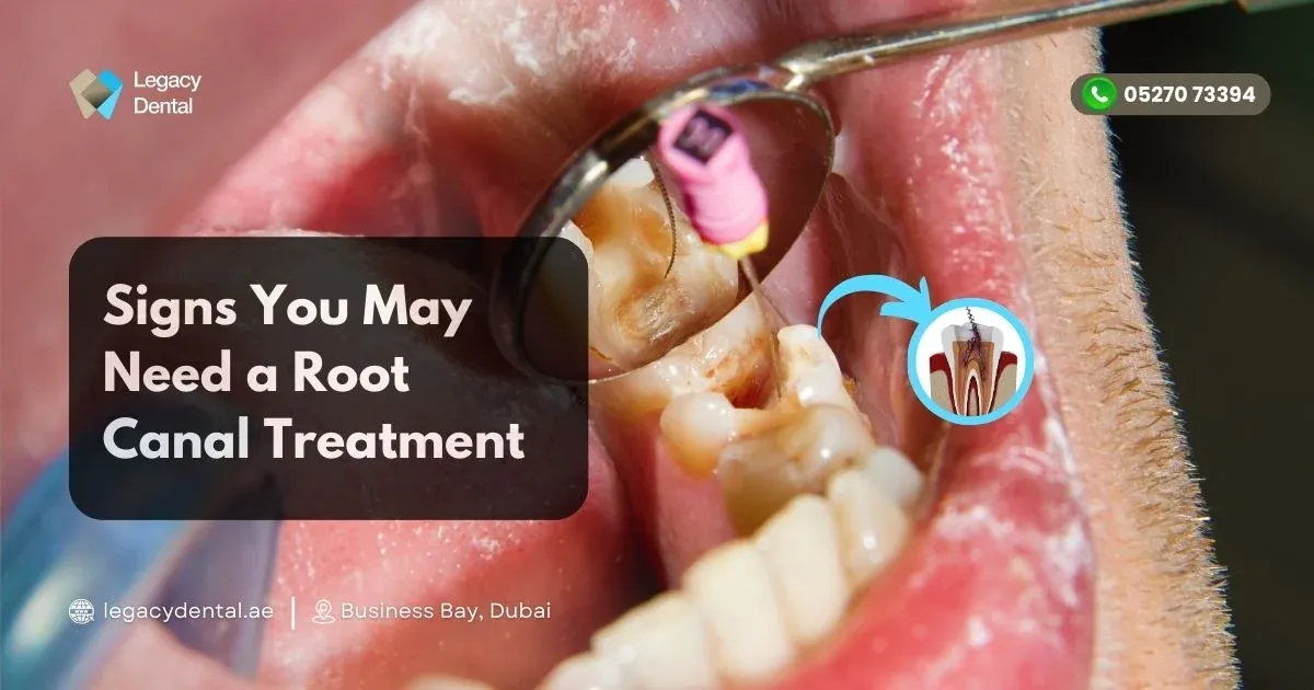When Your Tooth Talks: Signs You May Need a Root Canal Treatment