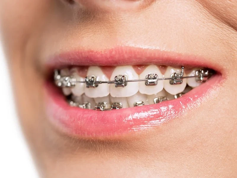1. Traditional Metal Braces