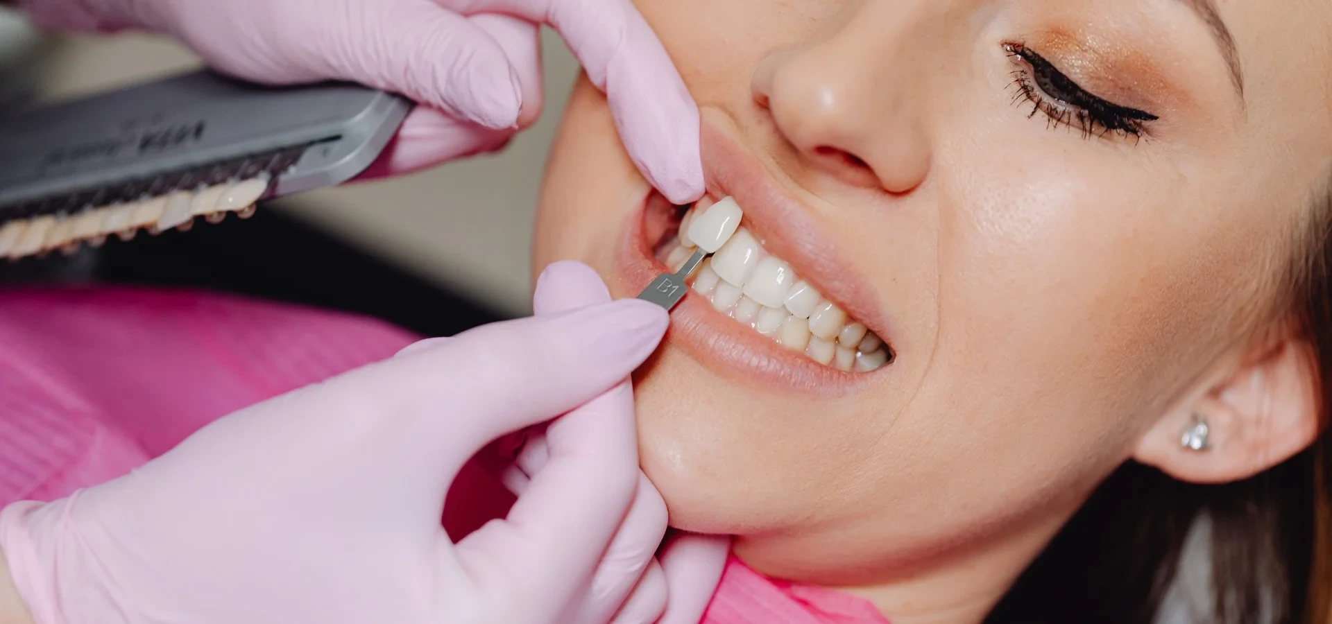 A veneer being fitted to a front tooth