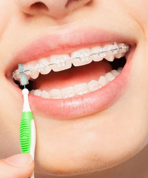 Ceramic Braces in Dubai