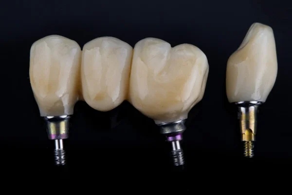 Dental Bridges in Dubai