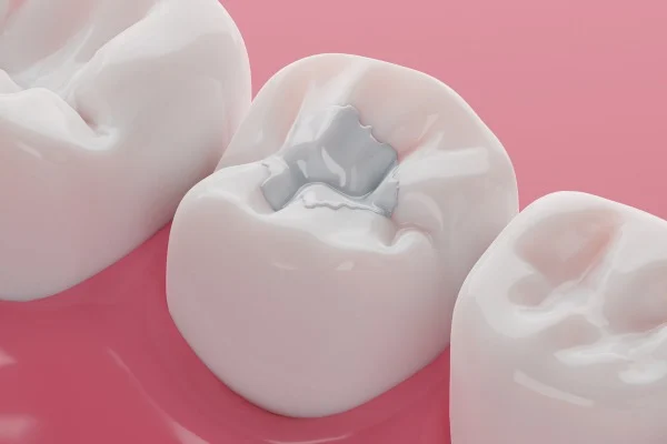 Composite Resin Fillings in Dubai