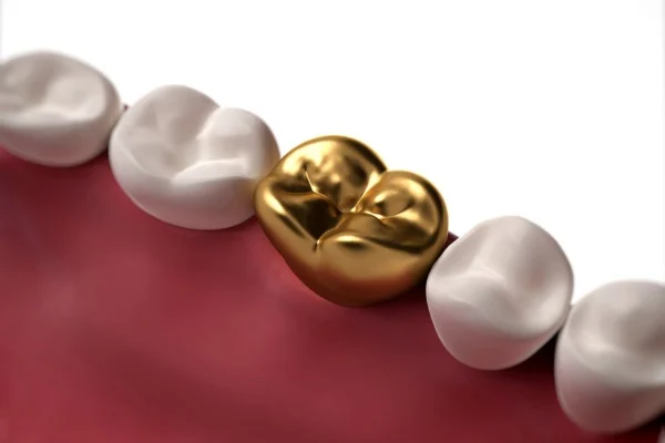 Gold Fillings in Dubai