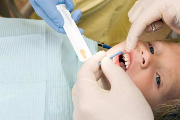 Fluoride Treatments in Dubai