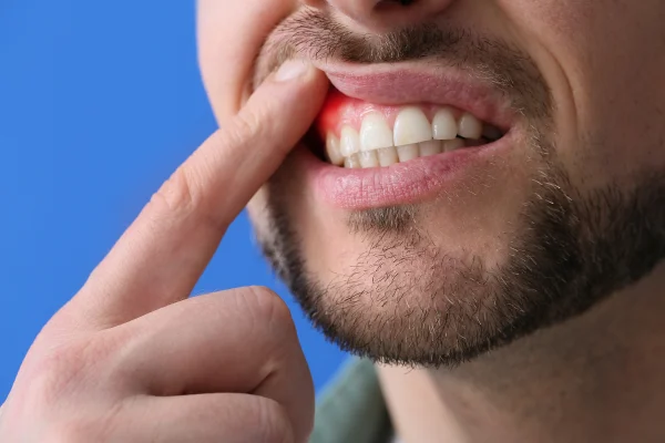 Gum Treatment in Dubai