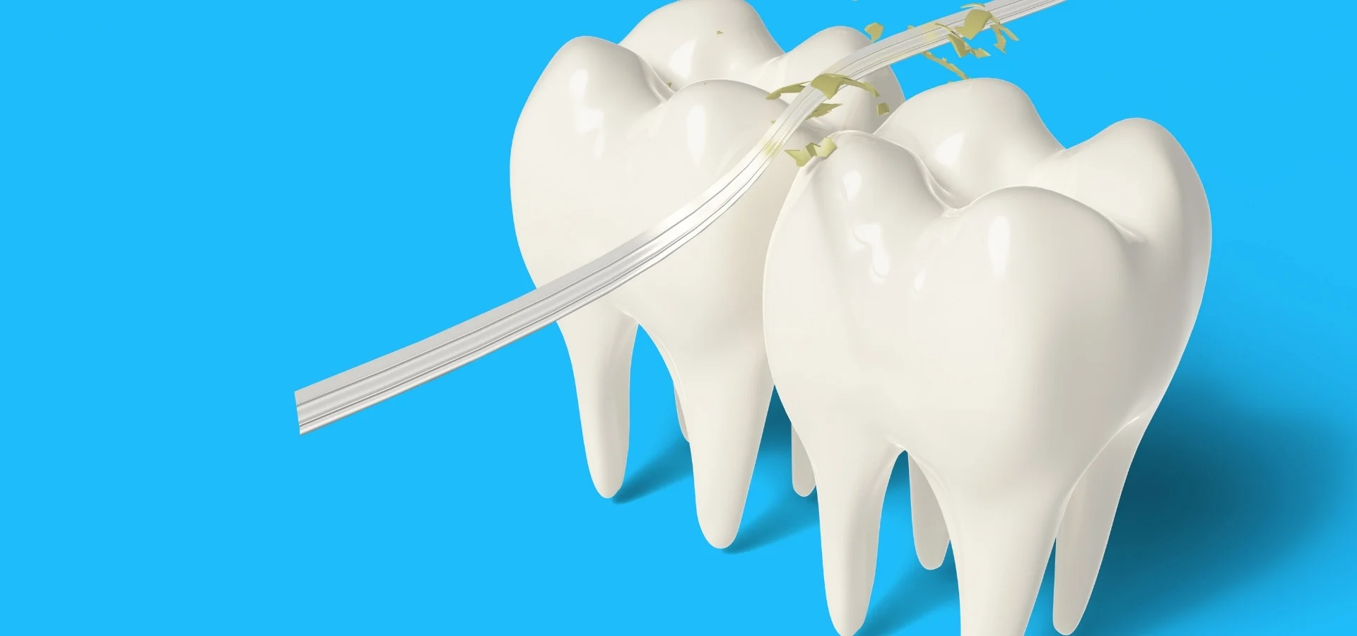 Inlays and Onlays in Dubai