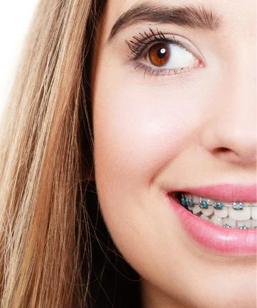 Damon Braces in Dubai