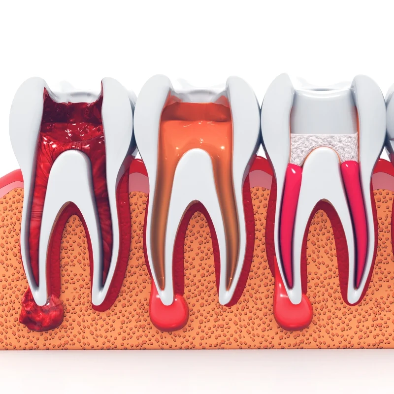 Re-Root Canal Treatment in Dubai