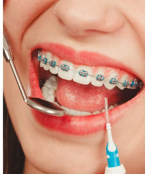 Dental Braces in Dubai