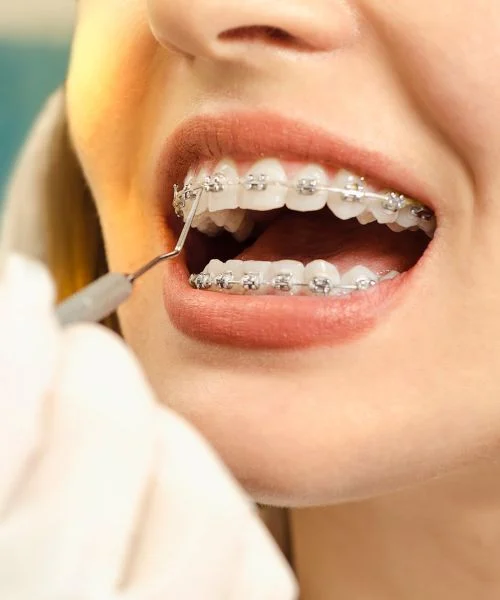 Self-Ligating Braces in Dubai