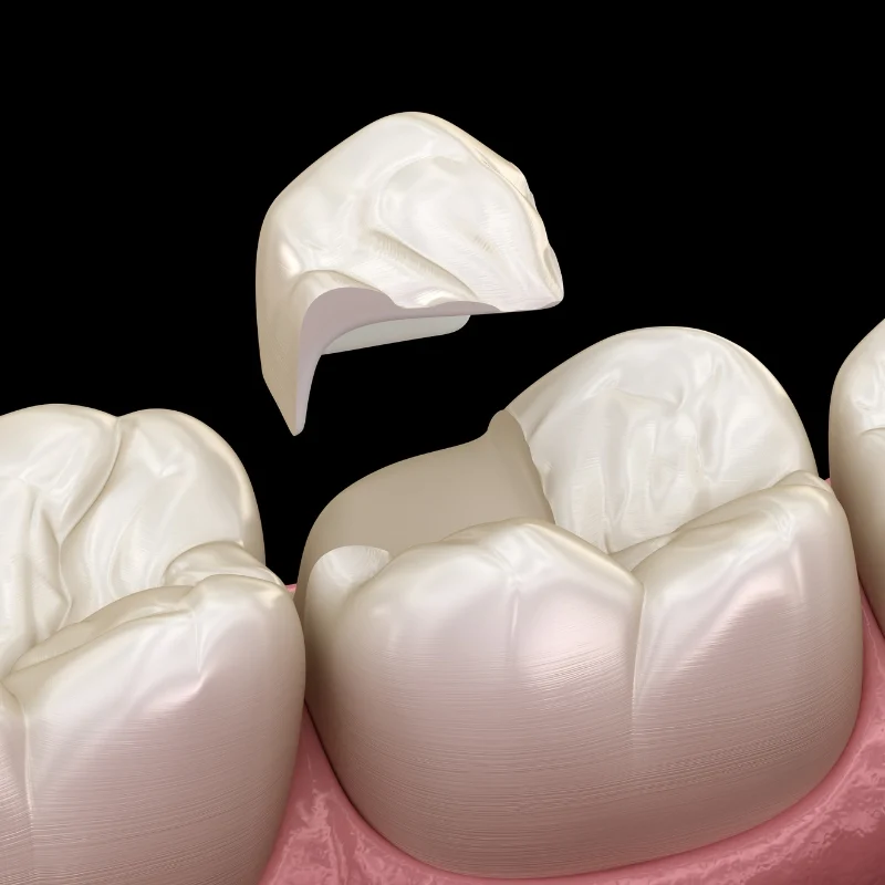 Dental Crowns in Dubai